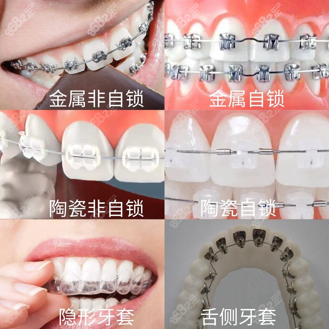 牙齿矫正常见的几种牙套类型哪种好？ - 哔哩哔哩
