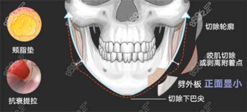 成都磨骨项目图