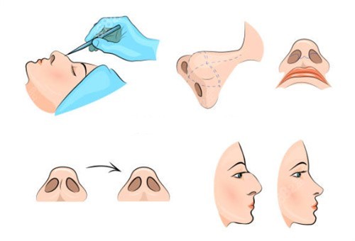 成都鼻综合手术
