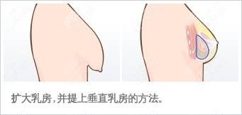 乳房下垂示意图