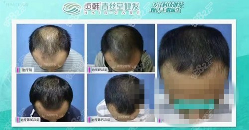 柳州贞韩植发前后对比照