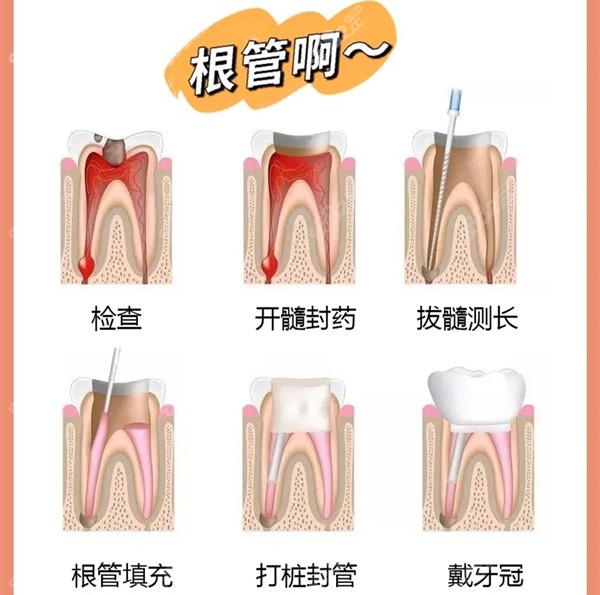 西安根管治疗和全瓷牙冠的费用