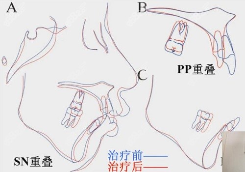 王雪东骨关节病患者II类正畸矫治