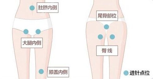大腿吸脂进针点位