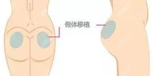 假体丰臀会不会很硬很假