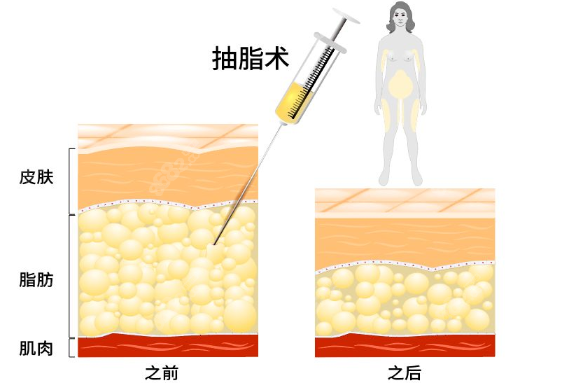 成都抽脂好的医生医院