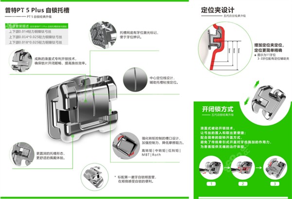 国产普特自锁托槽怎么样