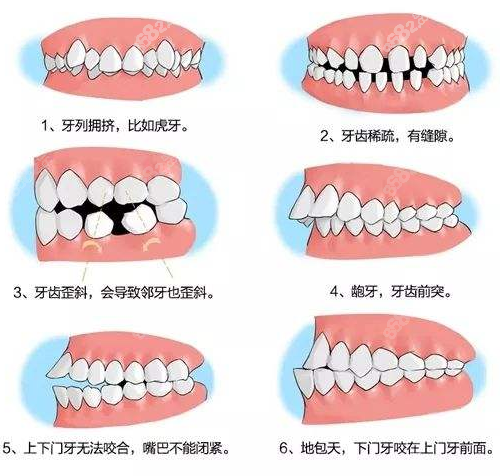 泉州牙齿矫正可以改善牙齿情况