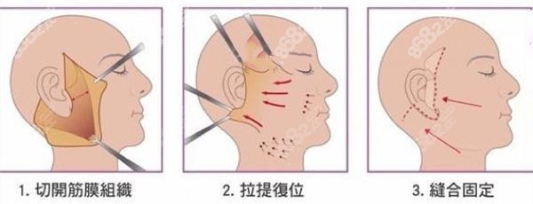 成都做中面部小拉皮除皱过程