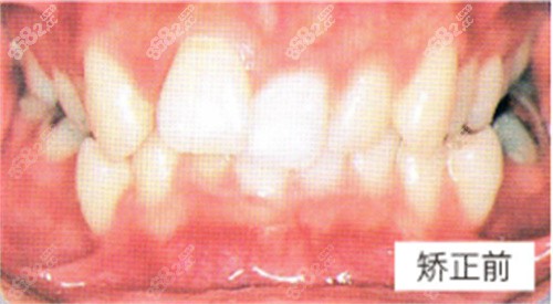 昆明柏德口腔成人深覆盖矫正前