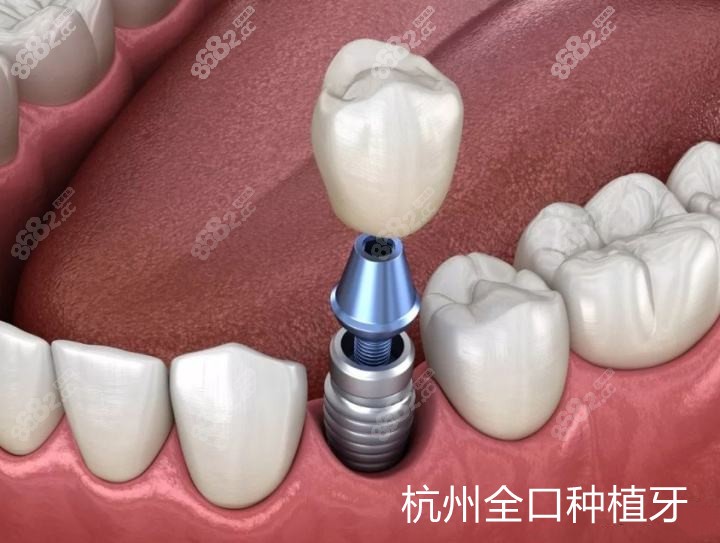 杭州全口种植牙牙科推荐