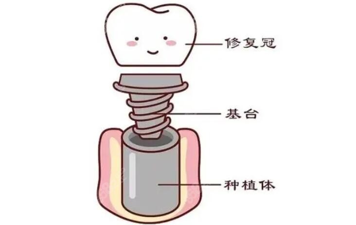 种植牙的构成