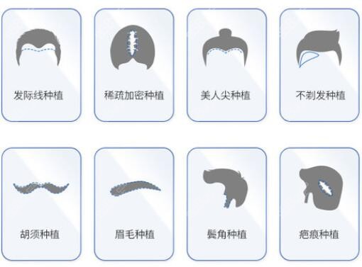 植发的不同部位