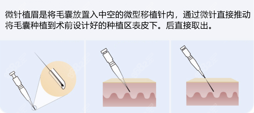 什么是微针植眉