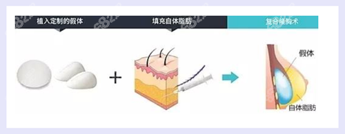 復(fù)合隆胸是先放入假體還是先注射脂肪？