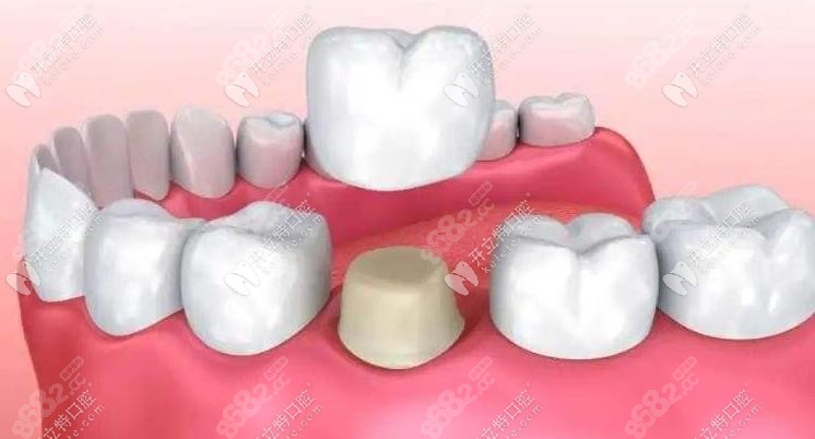 单颗假牙不影响做牙齿矫正