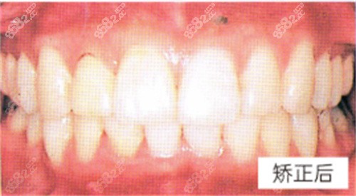 昆明柏德口腔成人深覆盖矫正后