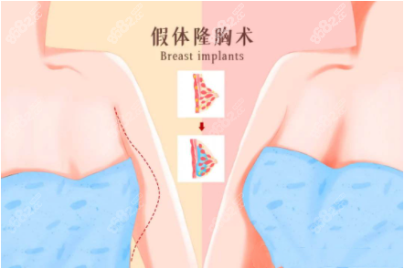 昆明假体隆胸做得好的医院有谁呢？