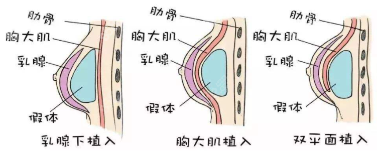 假体隆胸植入方式
