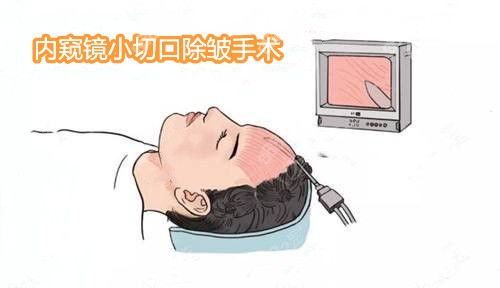 成都做内窥镜小切口除皱手术