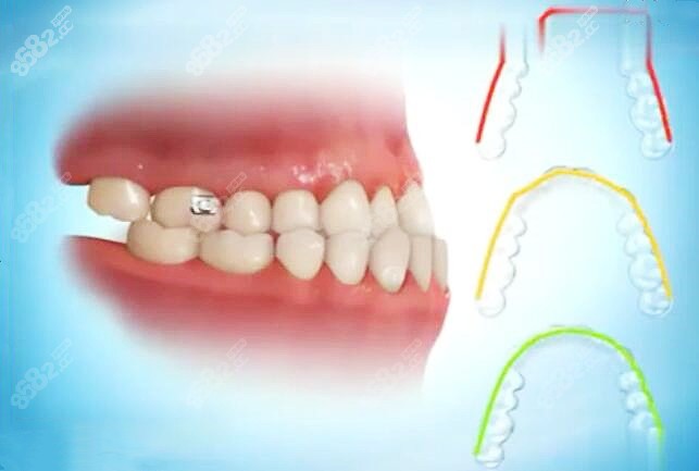 地包天做隐形矫正的过程图