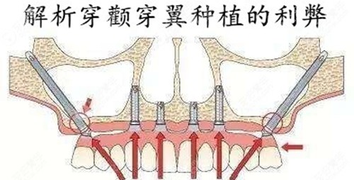 南昌穿颧穿翼牙齿种植技术