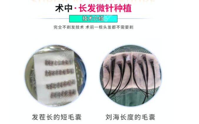 碧莲盛取不剃发植发的毛囊图