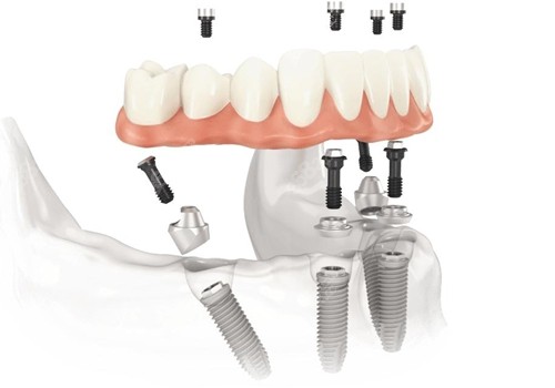 南昌All-on-4全半口牙齿种植技术