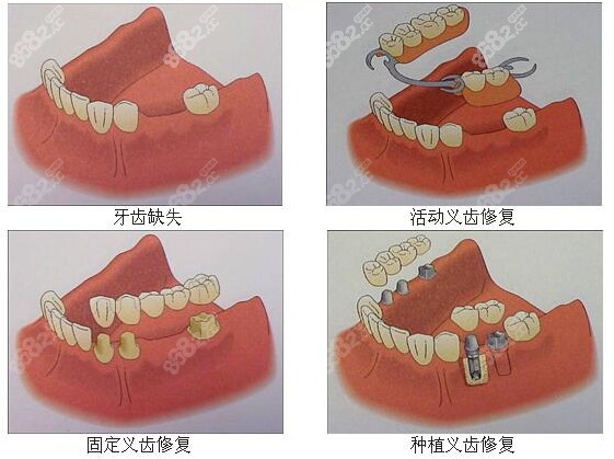 牙齿缺失的几种修复方式优缺点了解下