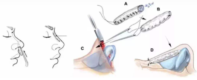 鼻综合手术过程图示