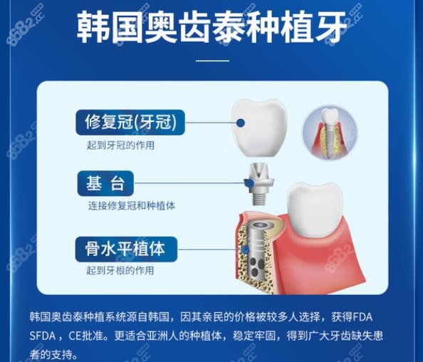 常州种植牙齿多少钱一颗跟你选择的植体品牌有关