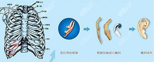 河南中医药大学第 一附属医院全耳再造手术示意图