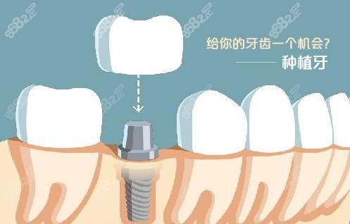 <!--<i data=20240705-sp></i>-->口腔做种植牙好不好？