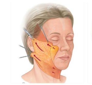 北京华韩做拉皮失败修复手术示意图