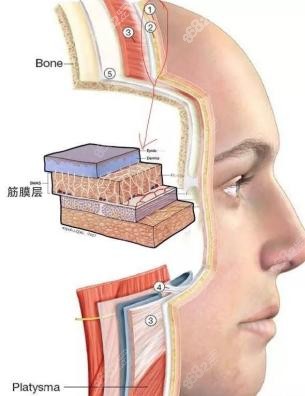 V美减龄面部提升作用层次示意图