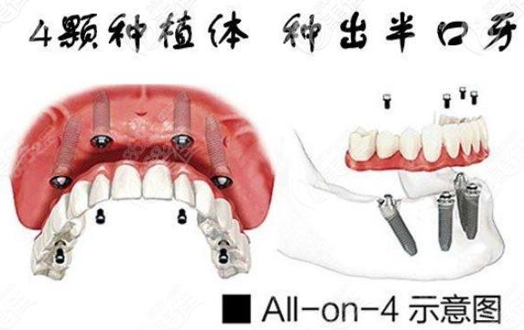 ALL-ON-4种植技术