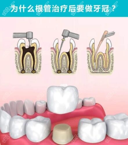 根管治疗后瓷牙套要戴多久