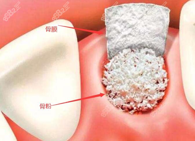 牙骨膜纤维图片