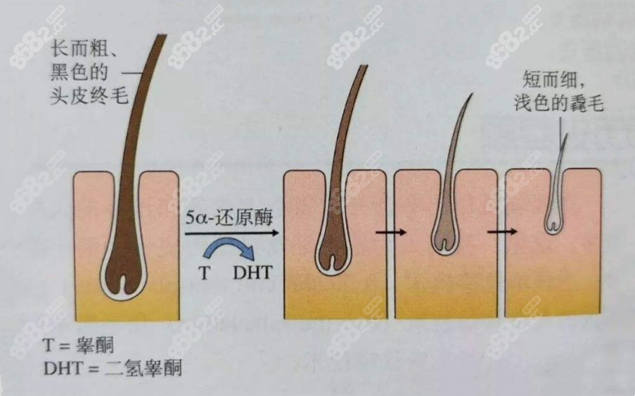 非长寿毛囊会被DHT攻击得越来越细小直至枯萎