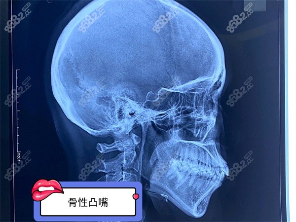 骨性嘴凸x光图片