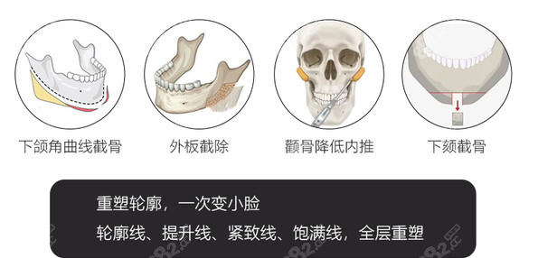 重庆星荣整形做轮廓手术过程