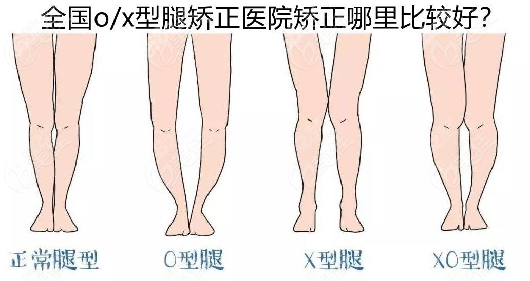 O型或x型腿型矫正医院去哪里做比较好