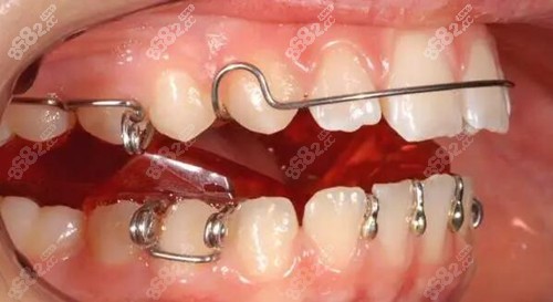 儿童替牙期矫正地包天会反弹吗要看牙齿地包天矫正器种类