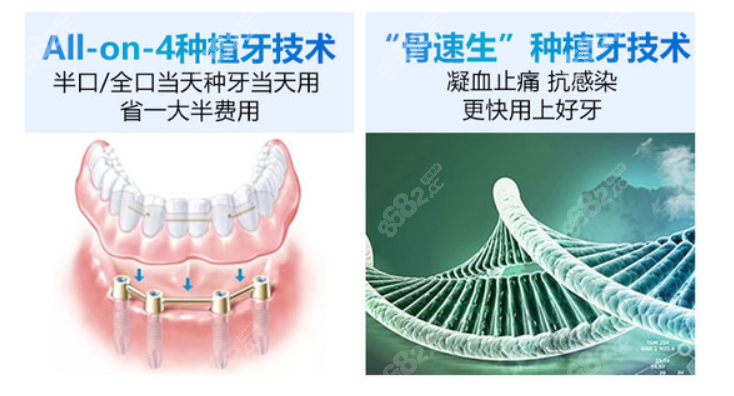 广州穗华口腔冯志强医生做种植牙怎么样