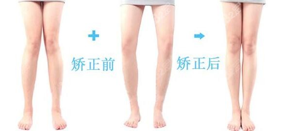 O型腿和x型腿矫正前后对比图片