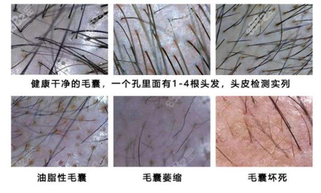 毛囊示意图
