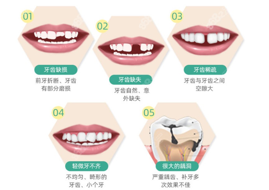 以下牙齿情况都可以通过镶牙来进行修复