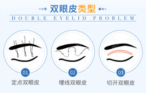 双眼皮有三种形状