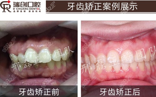 杭州瑞创口腔医院牙齿矫正真人实例