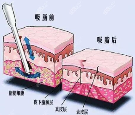 成都市吸脂手术医院排名